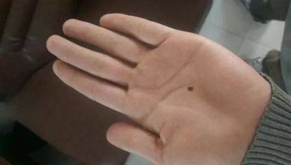 有“痣”者，须注意！磨擦可能带来的健康风险